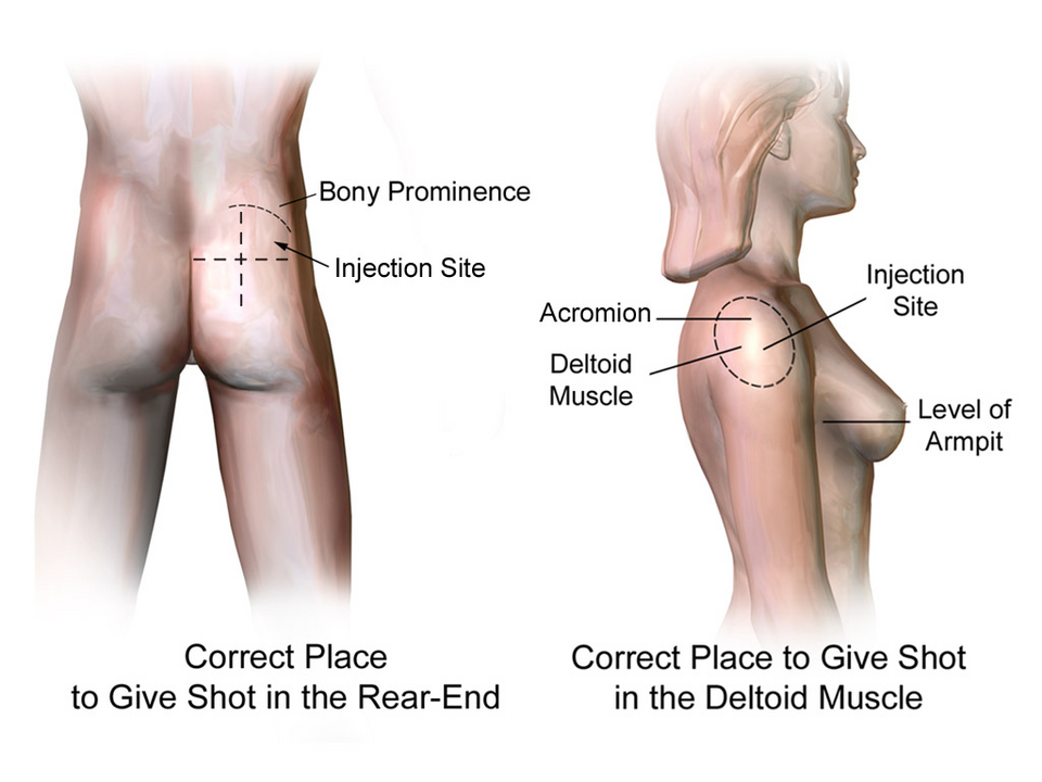 Intramuscular injection sites