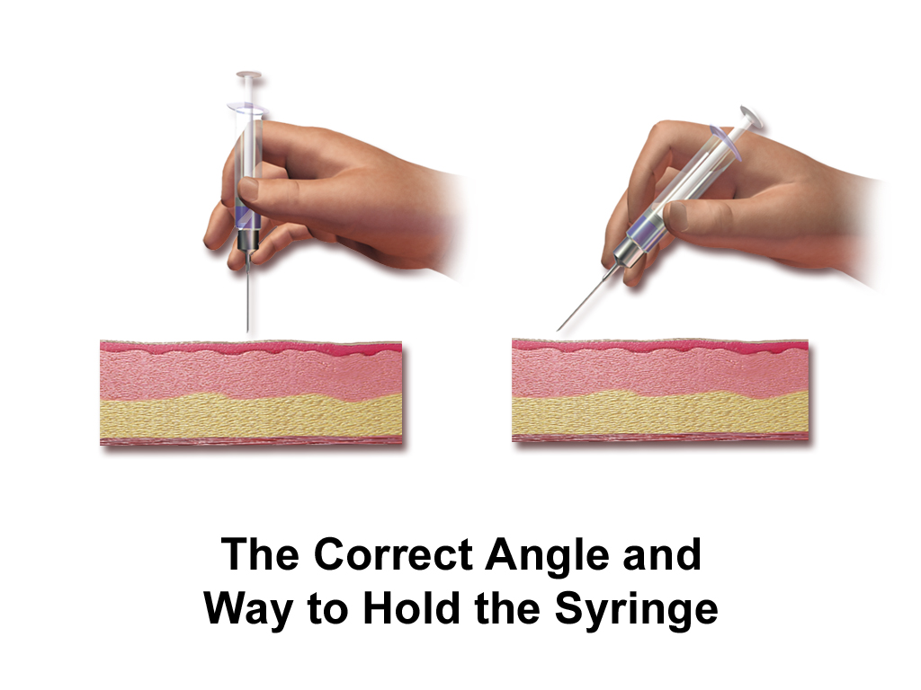 Correct angles for subcutaneous injection (45°)