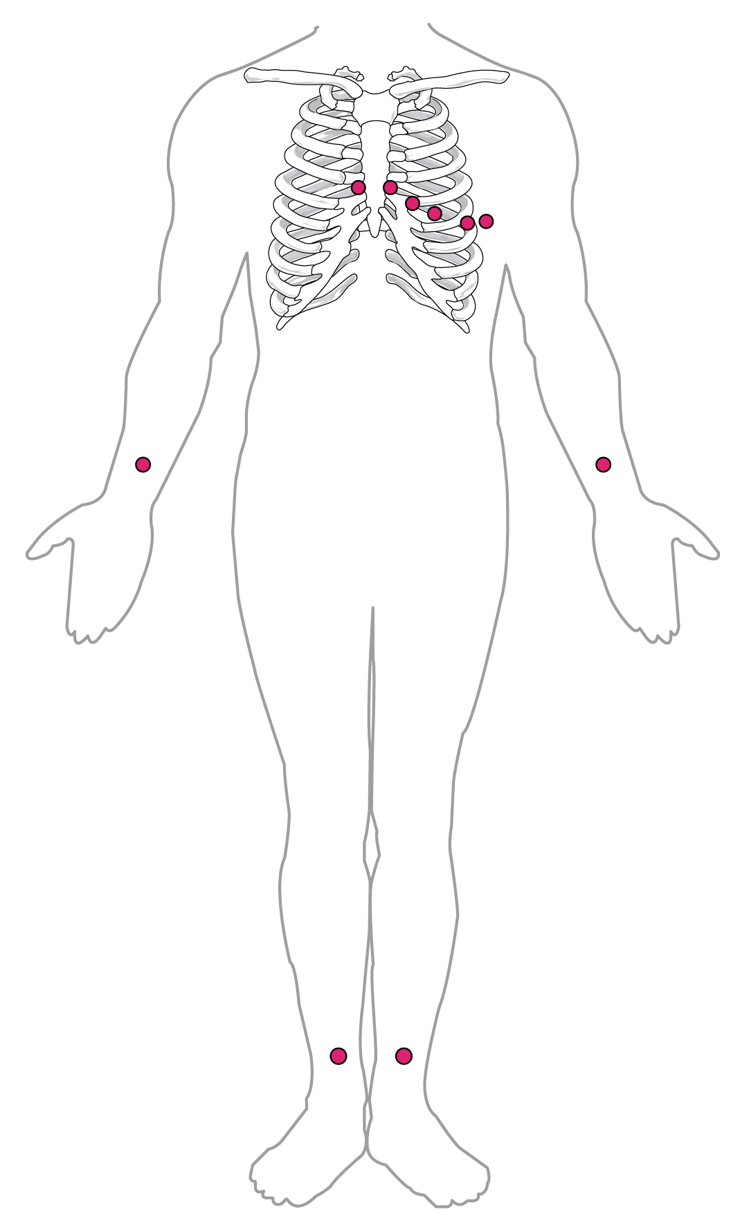 Standard 12-lead ECG electrode placement