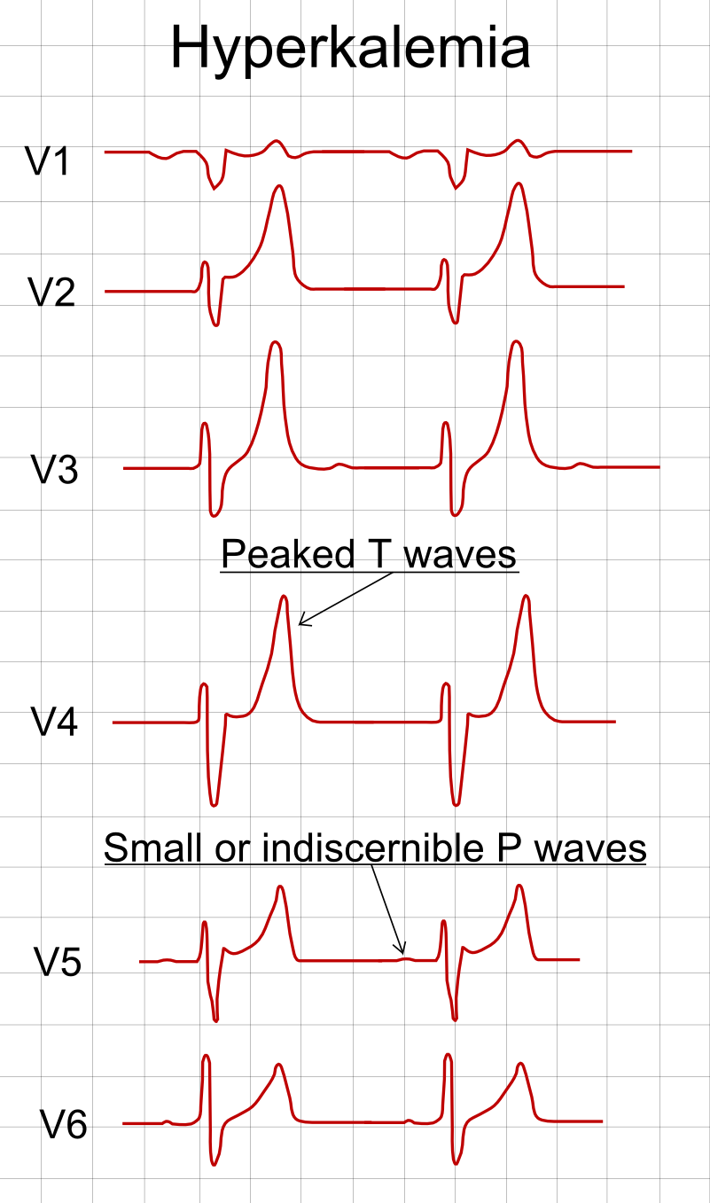 Precordial lead placement